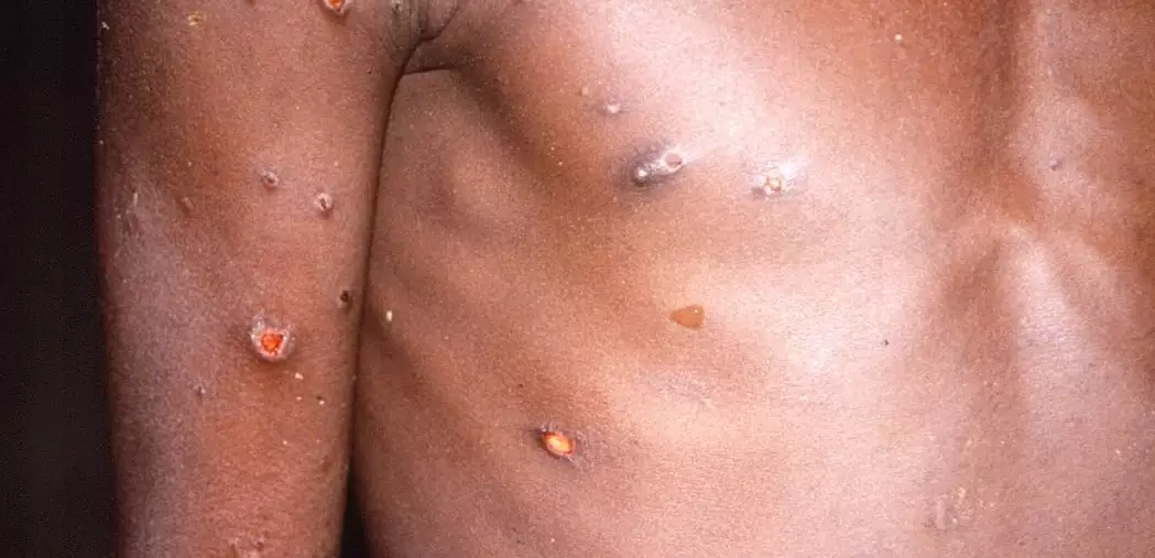 MS registra 1º caso suspeito de varíola dos macacosTrata-se de um adolescente, de 16 anos, morador de Porto Quijarro, na Bolívia